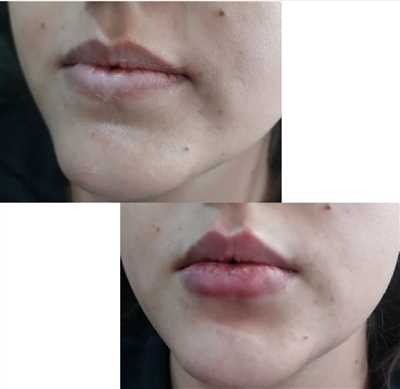 تزریق ژل وبوتاکس