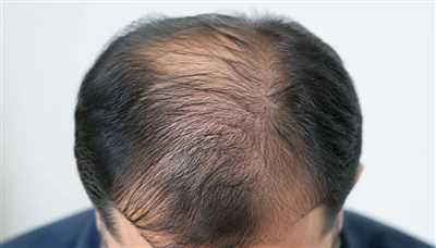 چه کسانی گزینه مناسب کاشت مو هستند؟ شرایط، محدودیت‌ها و نکات مهم