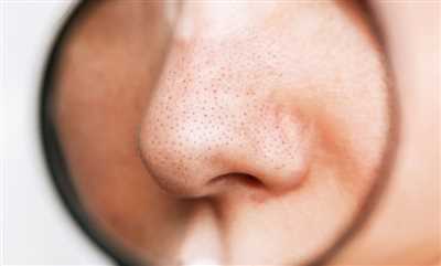 روش های از بین بردن منافذ باز بینی؛ رهایی از حفره‌های روی بینی