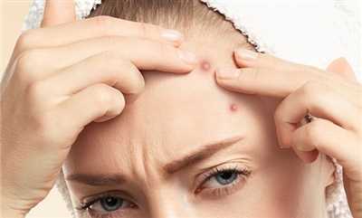 علت جوش پیشانی و بهترین راهکارهای درمان