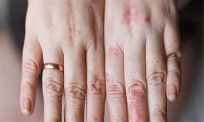 حساسیت به نقره؛ راهکارهای استفاده از نقره بدون بروز حساسیت