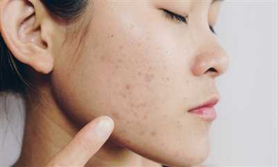 معرفی بهترین کرم برای جای جوش و لک صورت که باید بشناسید!
