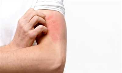 کمبود کدام ویتامین باعث خارش بدن میشود؟