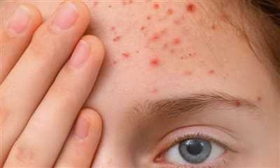 علت جوش پیشانی چیست؟ بررسی دلایل رایج و راه‌های کنترل آن