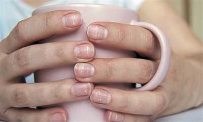 لکه سفید روی ناخن کمبود چه ویتامینی است؟