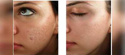 میکرونیدلینگ چیست؟ (روش جوانسازی پوست صورت)